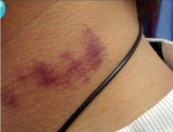 Muere joven por un ‘chupetón’ en el cuello